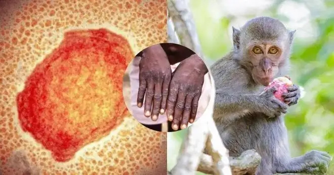 猴痘病毒，距離我們遠(yuǎn)嗎？